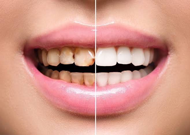 Teeth Whitening in Karachi