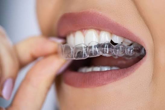 Invisible Aligners