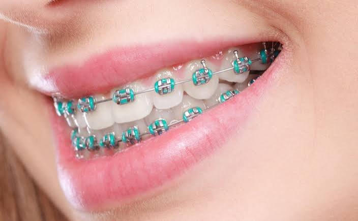 Braces Treatment in Karachi​