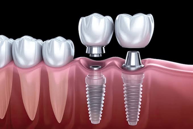 Dental Implants in Karachi