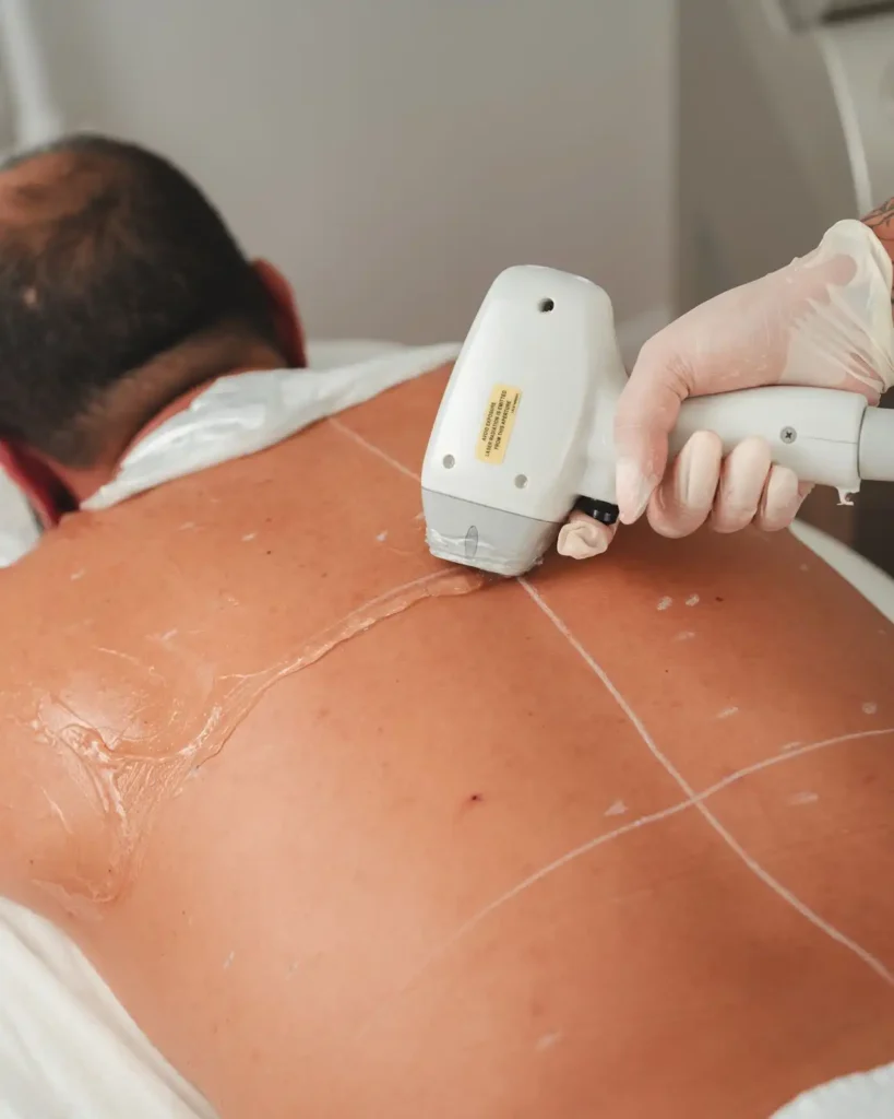 laser hair treatment for men